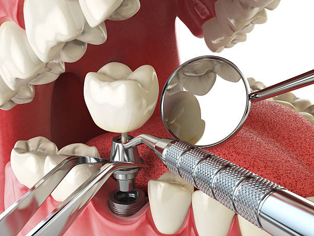 Best Emergency Tooth Extraction in Richfield, WI